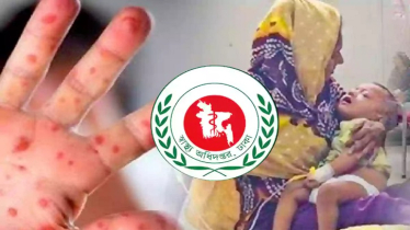 হামের উপসর্গে আরও ৩ শিশুর মৃত্যু, প্রাণহানি বেড়ে ৮৪০