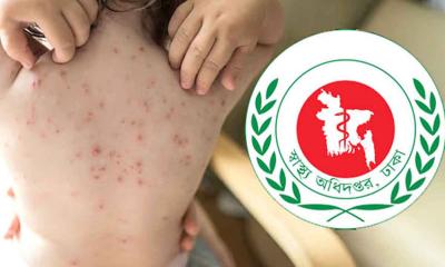সিলেটে হামের উপসর্গে আরও ৩ শিশুর মৃত্যু