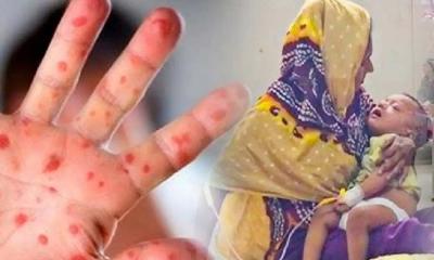 হাম ও হামের উপসর্গে আরও ৭ শিশুর মৃত্যু