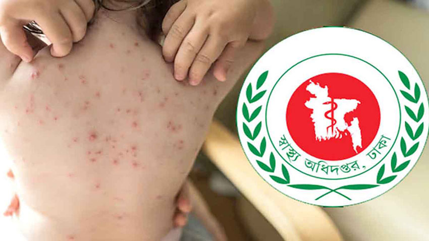 সিলেটে হামের উপসর্গে আরও ৩ শিশুর মৃত্যু