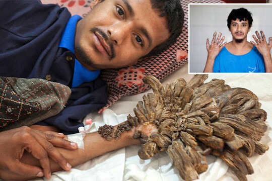 বৃক্ষমানব আবুল বাজনদারের বিরল রোগটি ফের দেখা দিয়েছে