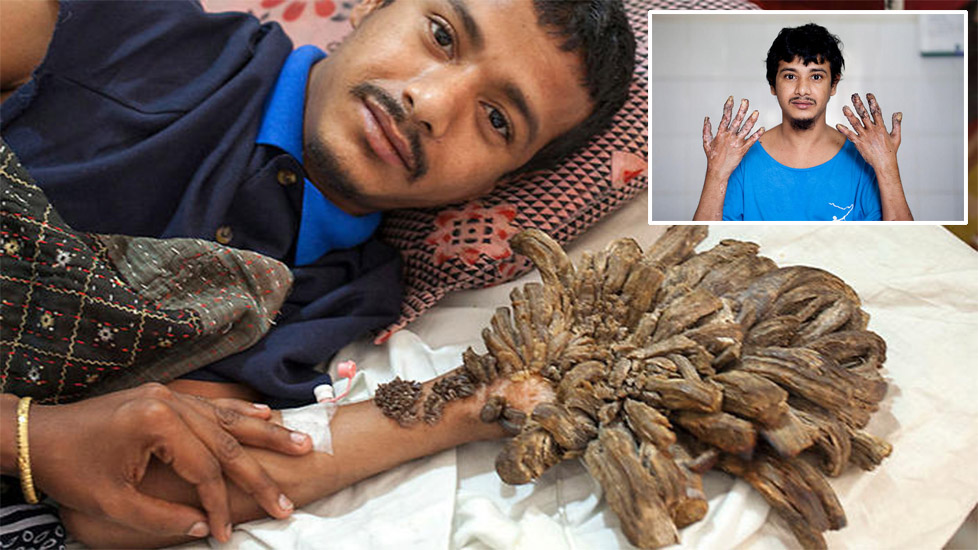 বৃক্ষমানব আবুল বাজনদারের বিরল রোগটি ফের দেখা দিয়েছে