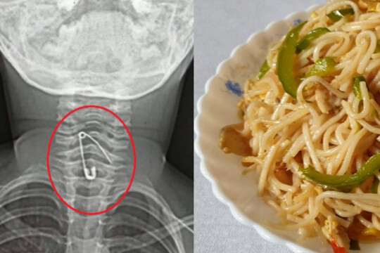 নুডুলস খাওয়ার সময় শিশুর গলায় আটকে গেলো সেফটিপিন!