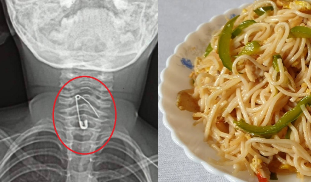 নুডুলস খাওয়ার সময় শিশুর গলায় আটকে গেলো সেফটিপিন!